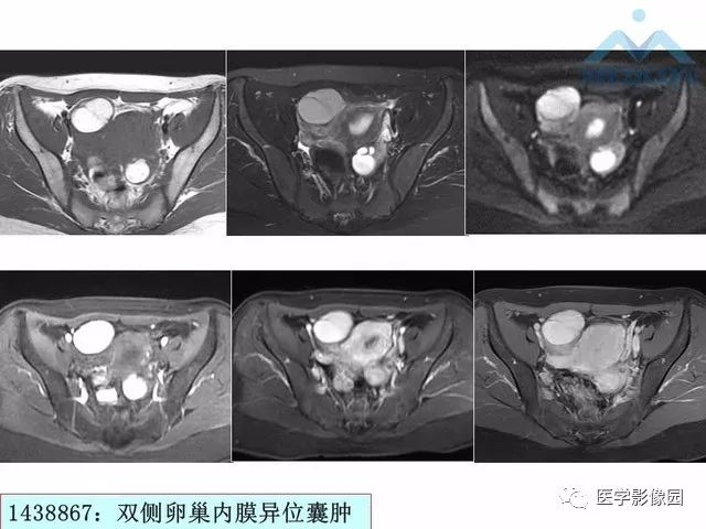 【PPT】MR对卵巢囊性病变的鉴别诊断价值