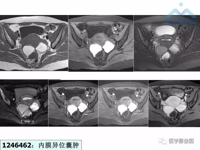 【PPT】MR对卵巢囊性病变的鉴别诊断价值