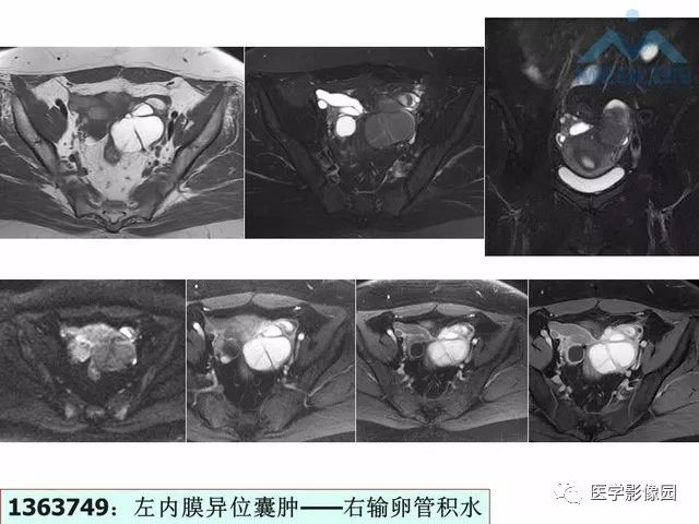 【PPT】MR对卵巢囊性病变的鉴别诊断价值