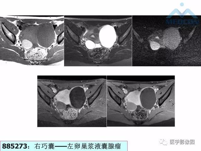 【PPT】MR对卵巢囊性病变的鉴别诊断价值