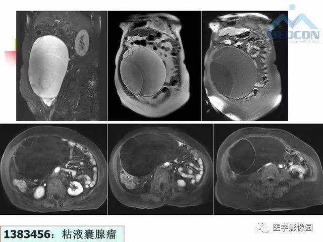 【PPT】MR对卵巢囊性病变的鉴别诊断价值