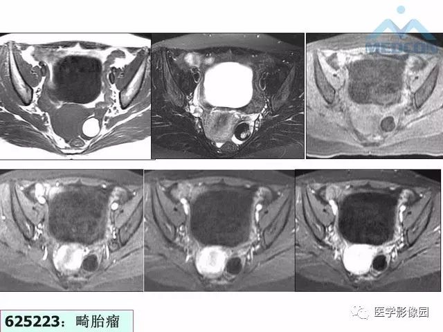 【PPT】MR对卵巢囊性病变的鉴别诊断价值