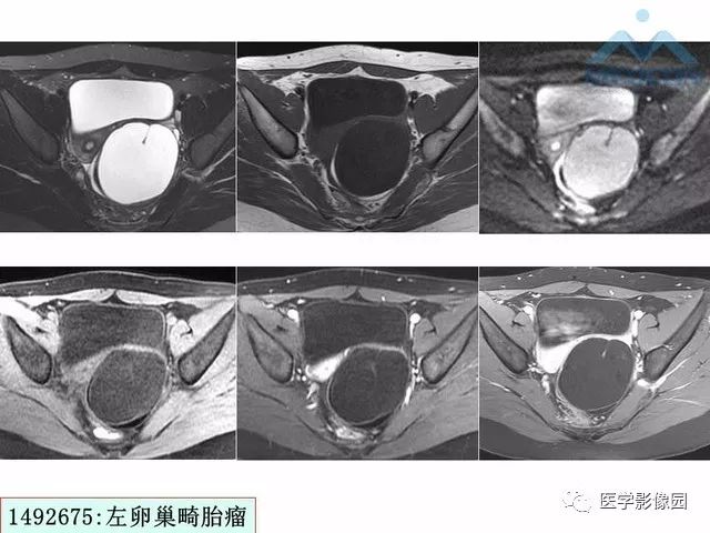 【PPT】MR对卵巢囊性病变的鉴别诊断价值