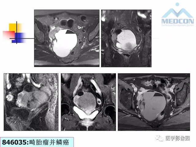 【PPT】MR对卵巢囊性病变的鉴别诊断价值
