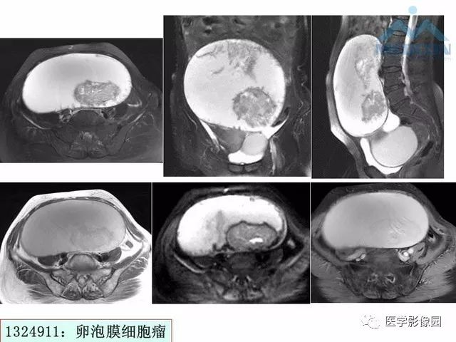 【PPT】MR对卵巢囊性病变的鉴别诊断价值