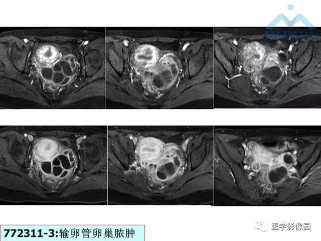 【PPT】MR对卵巢囊性病变的鉴别诊断价值