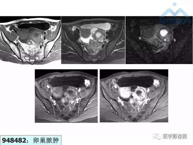 【PPT】MR对卵巢囊性病变的鉴别诊断价值