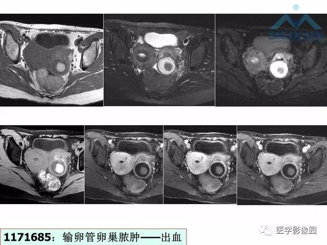 【PPT】MR对卵巢囊性病变的鉴别诊断价值