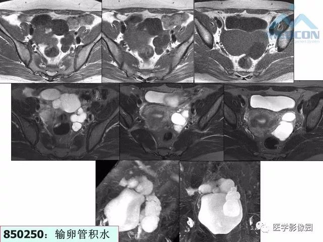 【PPT】MR对卵巢囊性病变的鉴别诊断价值