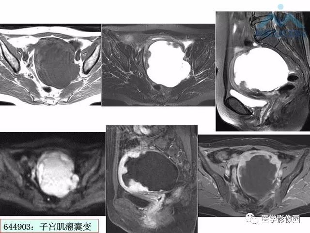 【PPT】MR对卵巢囊性病变的鉴别诊断价值
