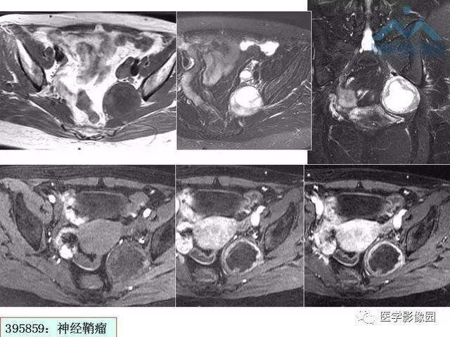 【PPT】MR对卵巢囊性病变的鉴别诊断价值