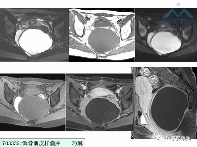 【PPT】MR对卵巢囊性病变的鉴别诊断价值