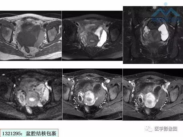 【PPT】MR对卵巢囊性病变的鉴别诊断价值