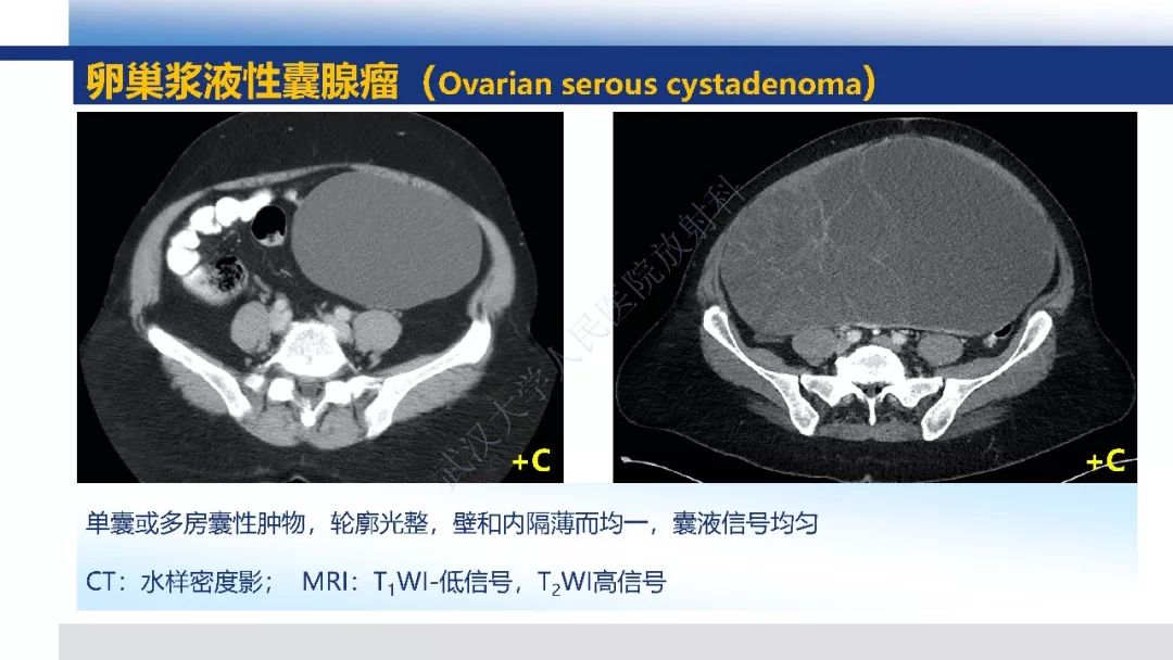 【PPT】女性盆腔囊性肿瘤性病变影像诊断