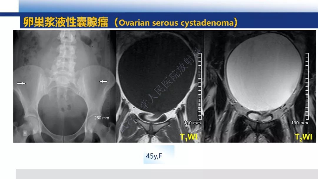 【PPT】女性盆腔囊性肿瘤性病变影像诊断