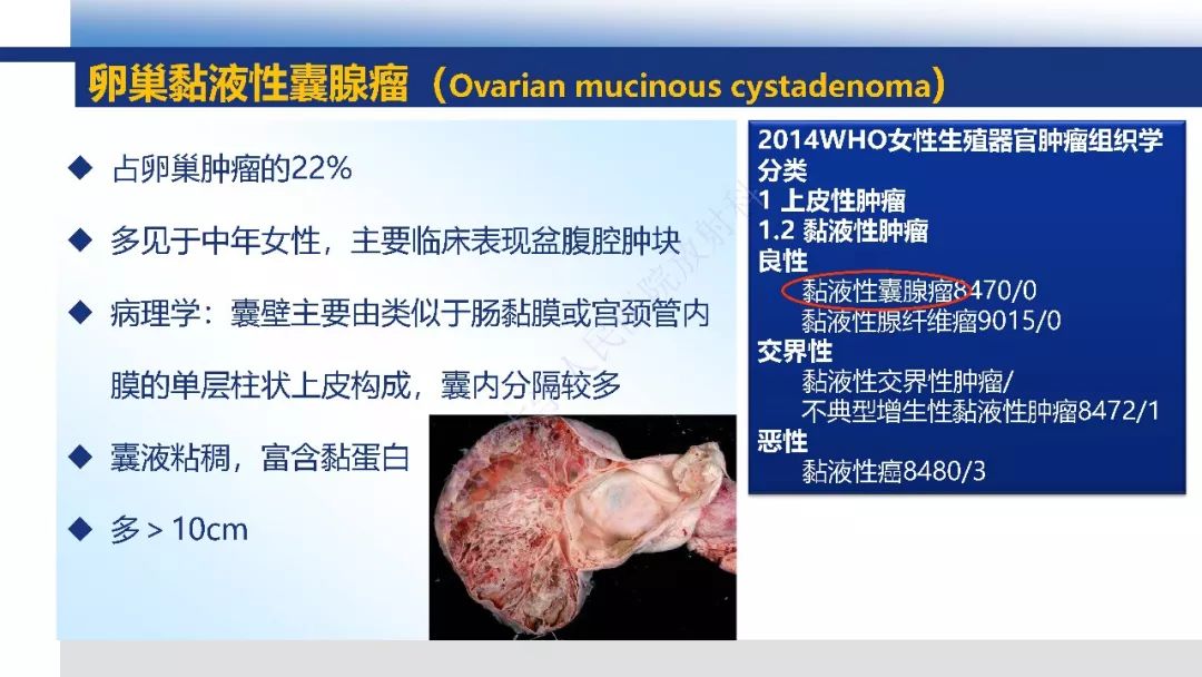 【PPT】女性盆腔囊性肿瘤性病变影像诊断