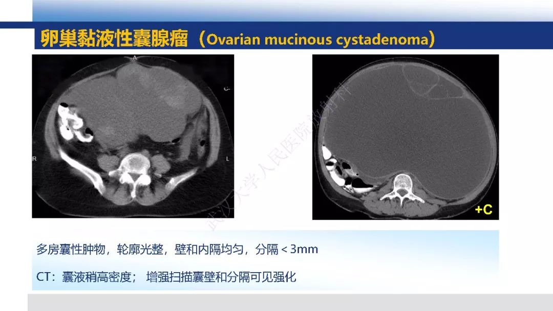 【PPT】女性盆腔囊性肿瘤性病变影像诊断