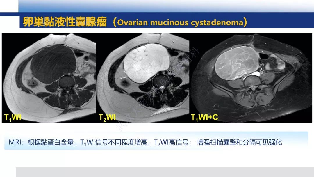 【PPT】女性盆腔囊性肿瘤性病变影像诊断