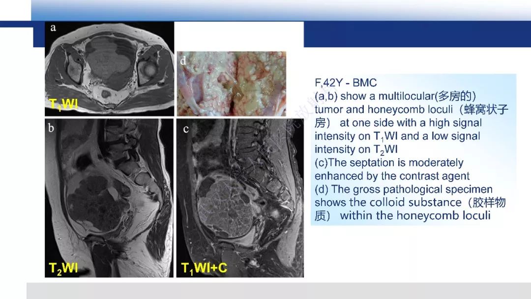【PPT】女性盆腔囊性肿瘤性病变影像诊断