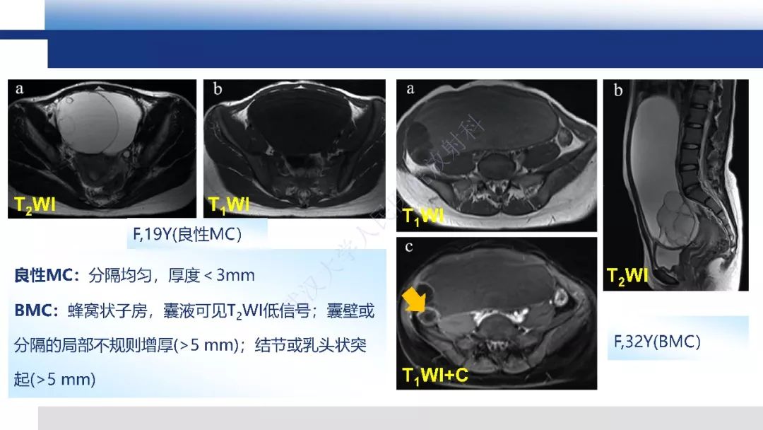 【PPT】女性盆腔囊性肿瘤性病变影像诊断
