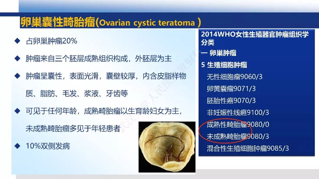 【PPT】女性盆腔囊性肿瘤性病变影像诊断