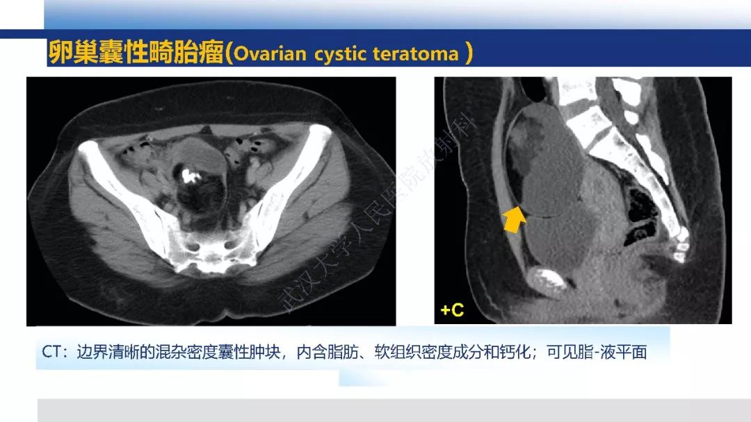 【PPT】女性盆腔囊性肿瘤性病变影像诊断