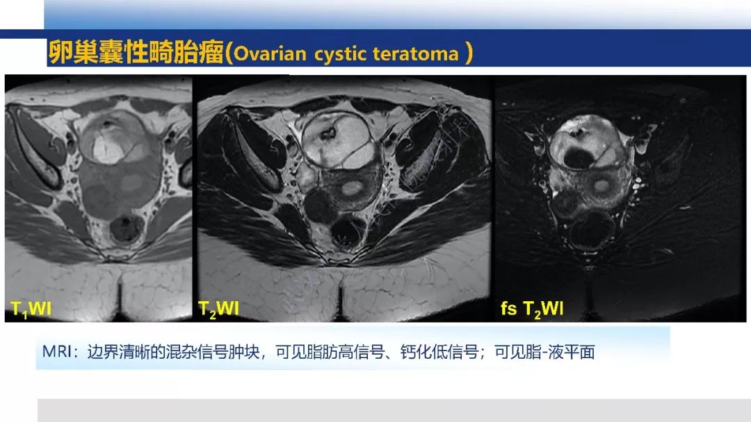 【PPT】女性盆腔囊性肿瘤性病变影像诊断
