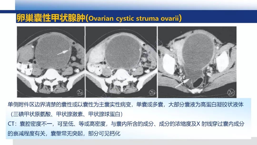 【PPT】女性盆腔囊性肿瘤性病变影像诊断