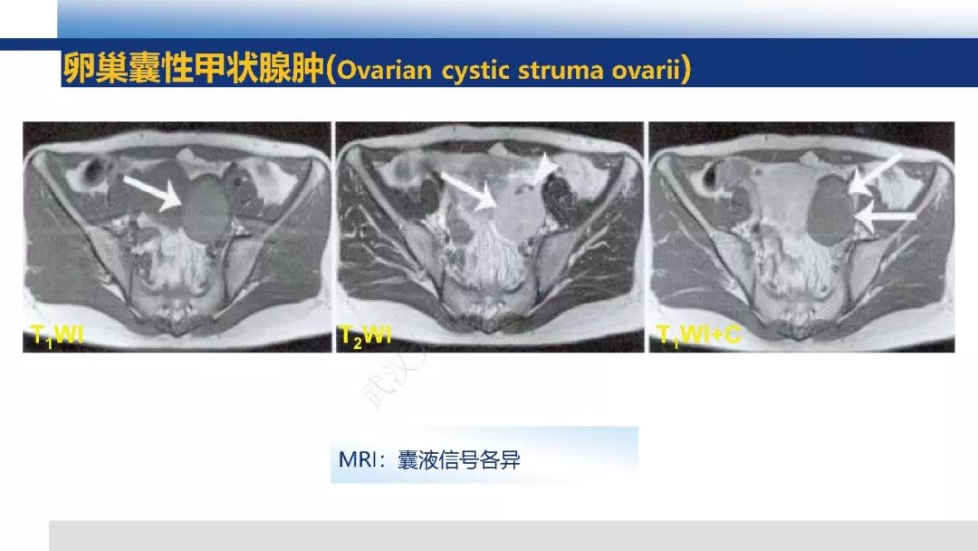 【PPT】女性盆腔囊性肿瘤性病变影像诊断