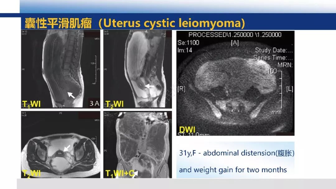 【PPT】女性盆腔囊性肿瘤性病变影像诊断
