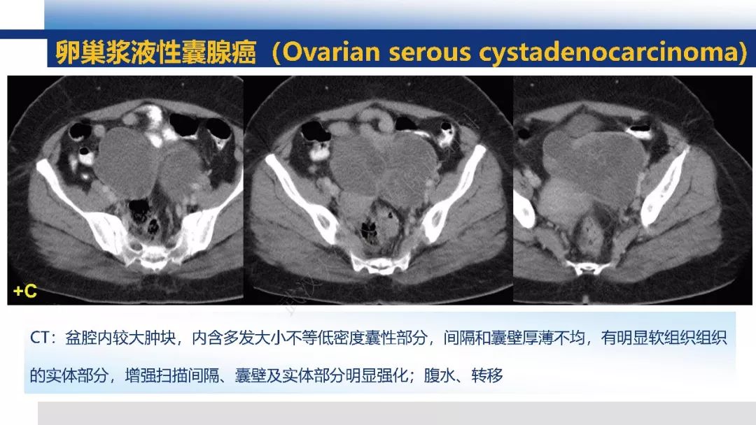 【PPT】女性盆腔囊性肿瘤性病变影像诊断