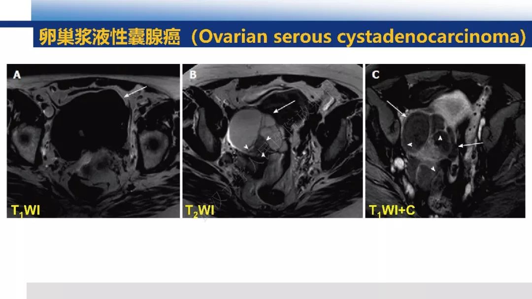 【PPT】女性盆腔囊性肿瘤性病变影像诊断