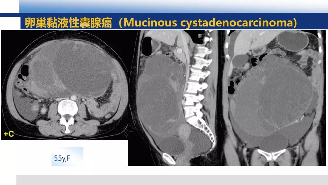 【PPT】女性盆腔囊性肿瘤性病变影像诊断