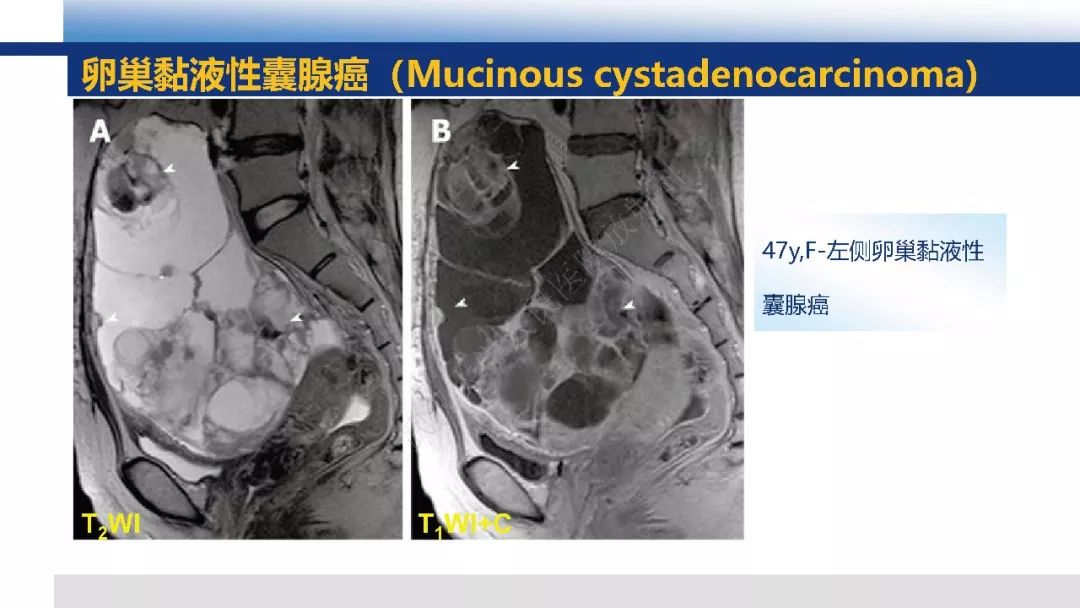 【PPT】女性盆腔囊性肿瘤性病变影像诊断