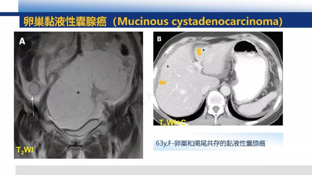 【PPT】女性盆腔囊性肿瘤性病变影像诊断