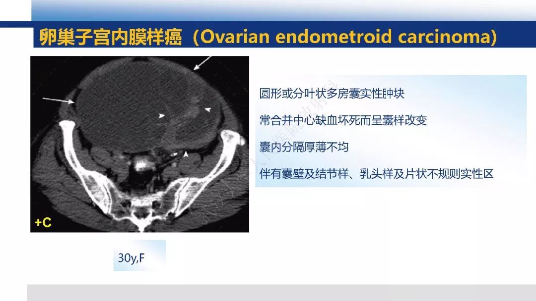 【PPT】女性盆腔囊性肿瘤性病变影像诊断