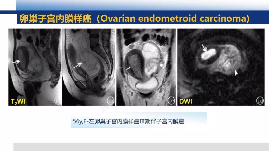 【PPT】女性盆腔囊性肿瘤性病变影像诊断