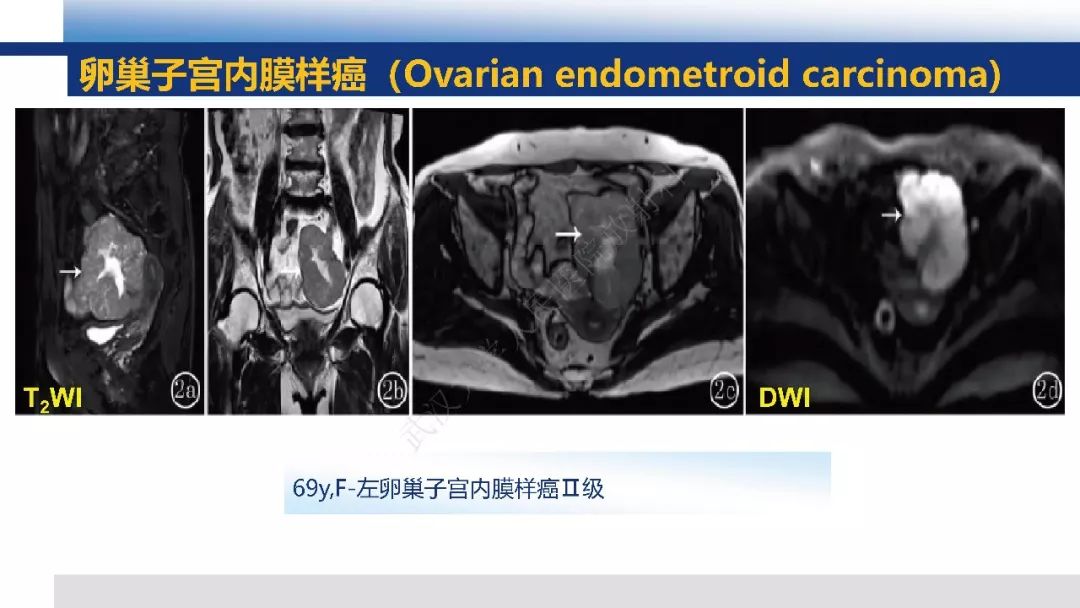 【PPT】女性盆腔囊性肿瘤性病变影像诊断