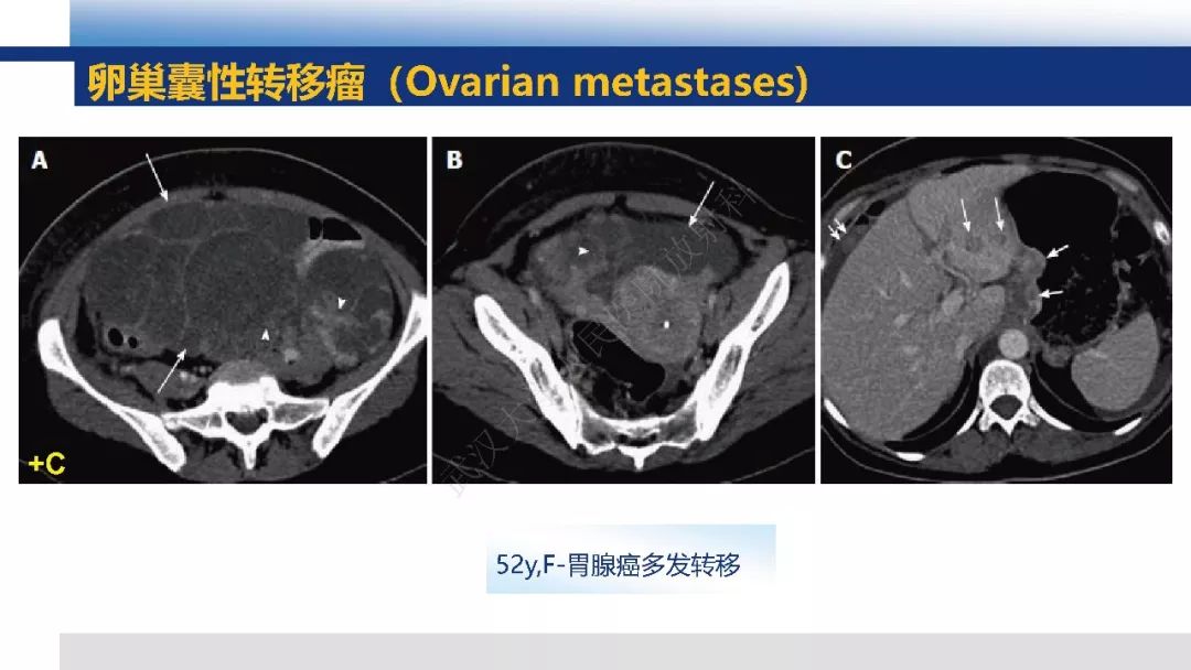 【PPT】女性盆腔囊性肿瘤性病变影像诊断