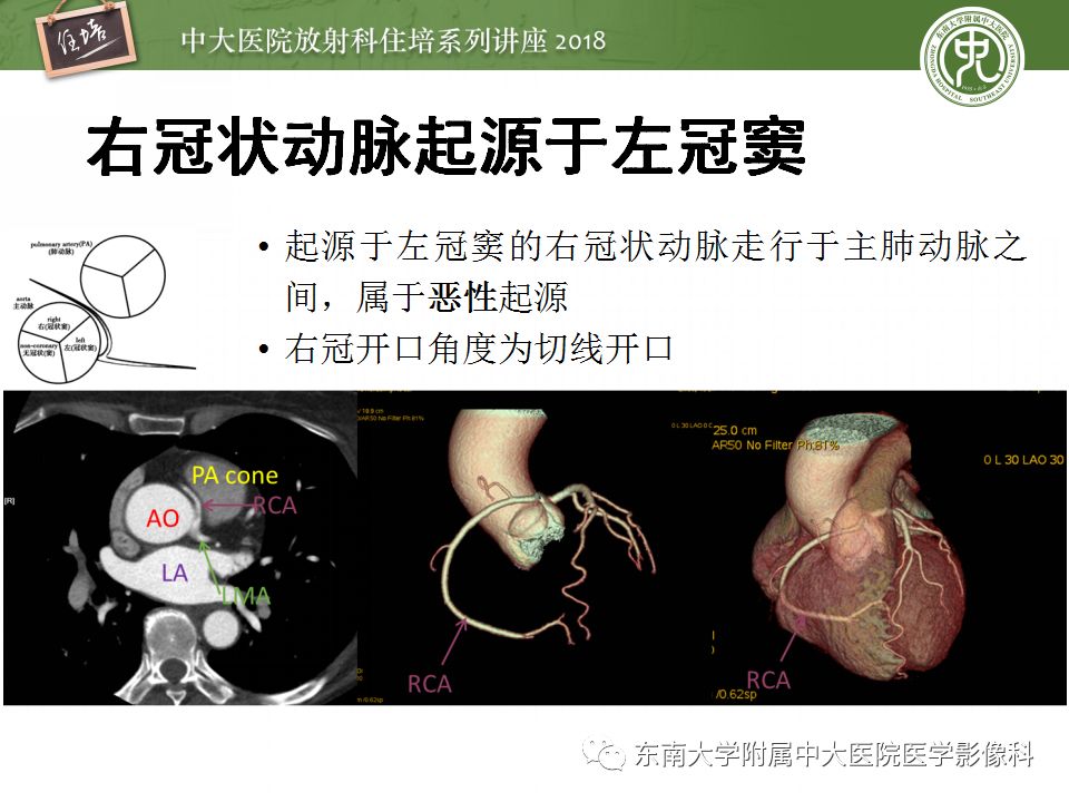 【PPT】冠脉CTA阅片要点及标准化报告