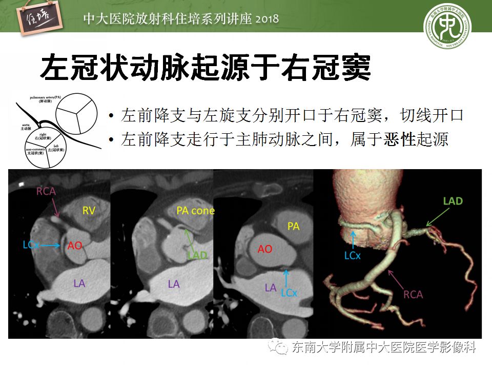 【PPT】冠脉CTA阅片要点及标准化报告