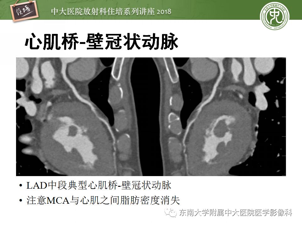【PPT】冠脉CTA阅片要点及标准化报告