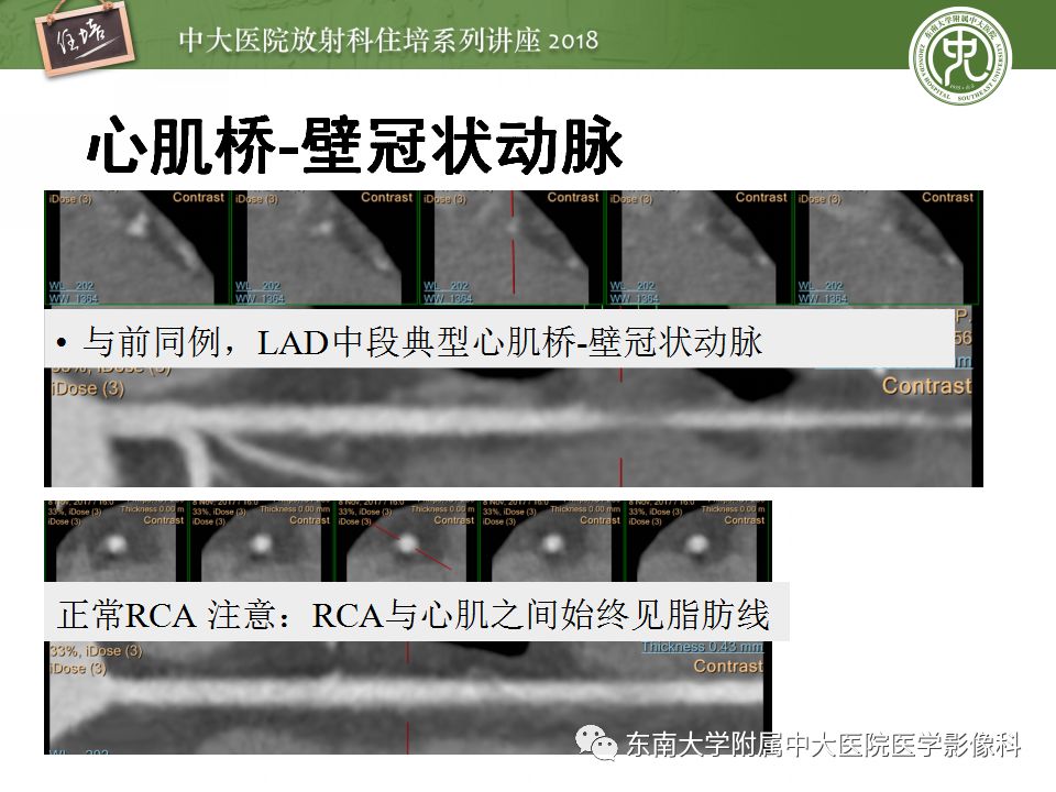【PPT】冠脉CTA阅片要点及标准化报告