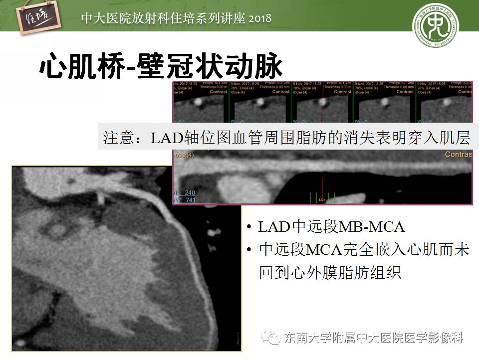 【PPT】冠脉CTA阅片要点及标准化报告
