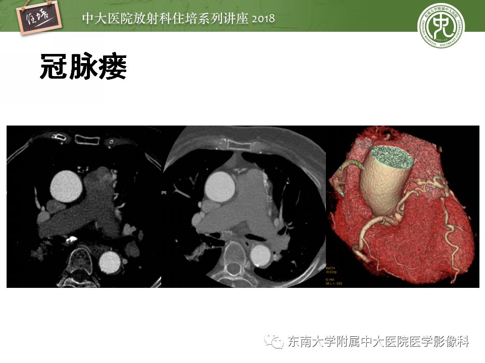 【PPT】冠脉CTA阅片要点及标准化报告