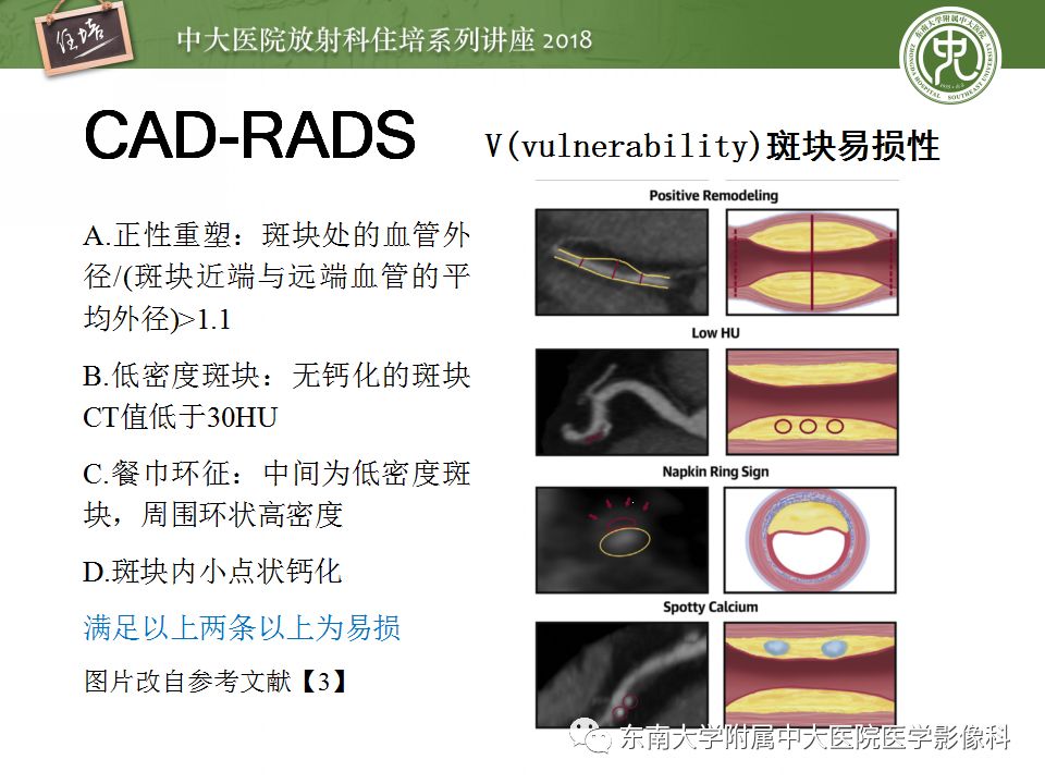 【PPT】冠脉CTA阅片要点及标准化报告