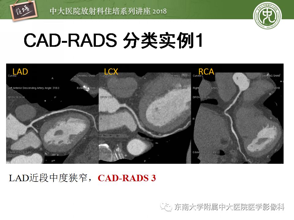 【PPT】冠脉CTA阅片要点及标准化报告