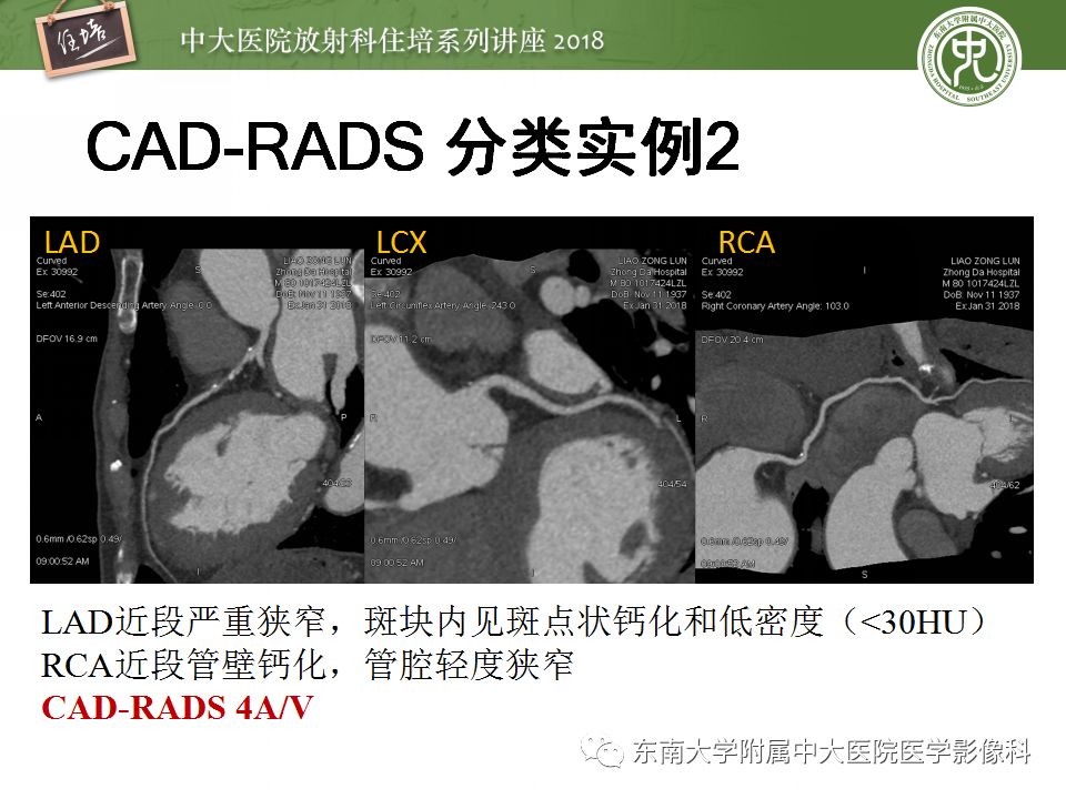 【PPT】冠脉CTA阅片要点及标准化报告