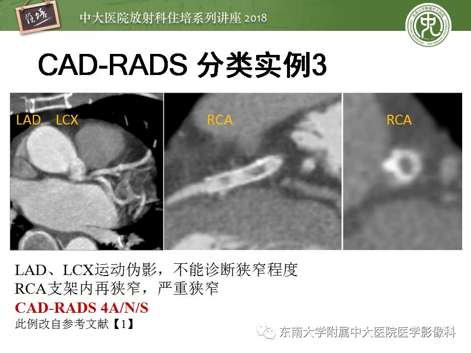 【PPT】冠脉CTA阅片要点及标准化报告