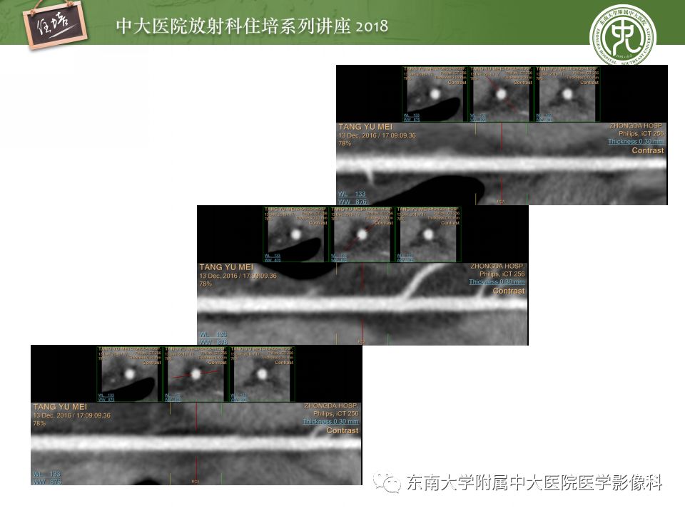 【PPT】冠脉CTA阅片要点及标准化报告